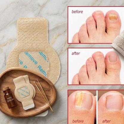 NAILCURE Parches para eliminar hongos